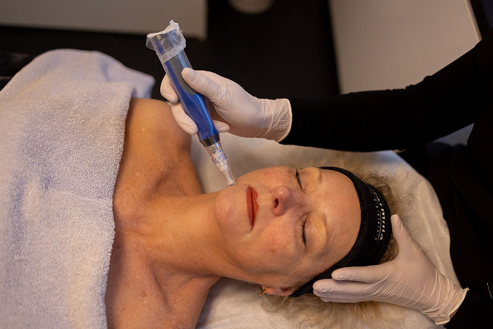 SkinPen medische microneedling